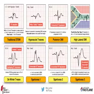 ECG STEMI Equivalents 2